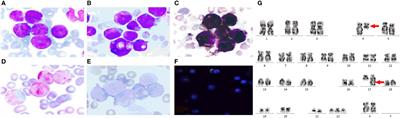 Acute promyelocytic leukemia with FIP1L1::RARA fusion gene: The clinical utility of transcriptome sequencing and bioinformatic analyses
